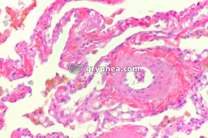 Emphysème pulmonaire x100 - gryphea.org